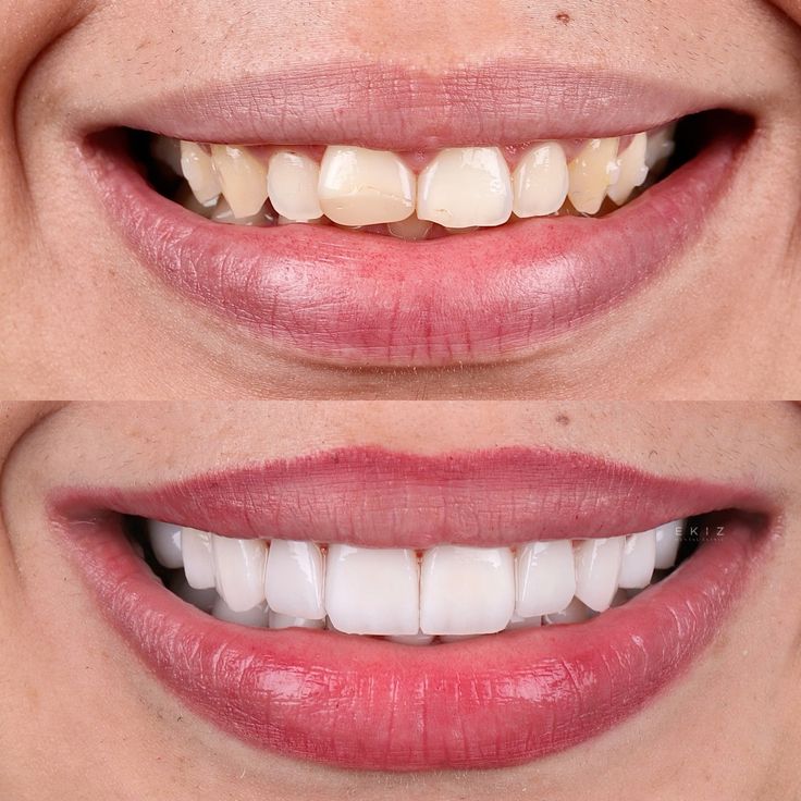 Smile Makeover Before After – Sanidhya Dental Rohini
